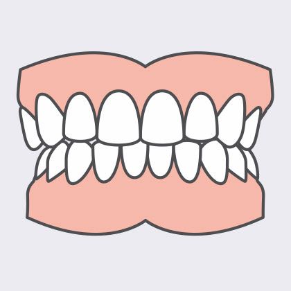 crossbite