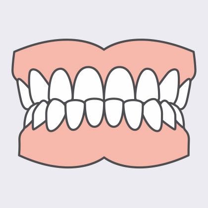 underbite