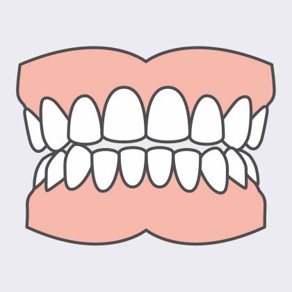 open bite