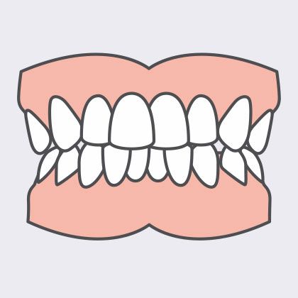 crowded teeth