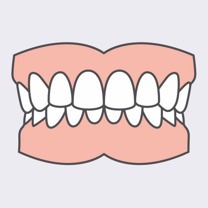 overbite