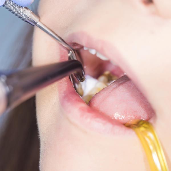 root canal treatment